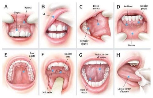 Sâu răng gây bệnh Ung Thư
