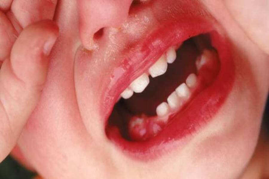 dấu hiệu nhận biết viêm nha chu ở trẻ em