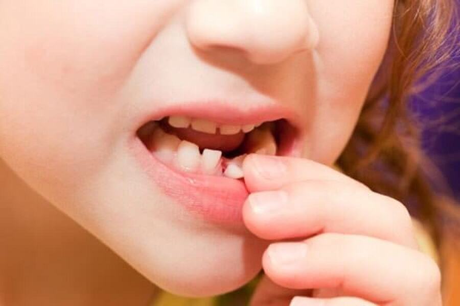 lung lay răng do bệnh viêm nha chu ở trẻ