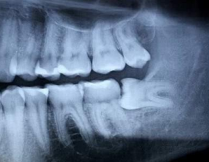 ảnh chụp x quang răng số 8 mọc lệch