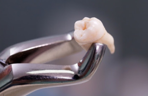 Nên hay không nhỏ răng số 8 tại Vinsmile