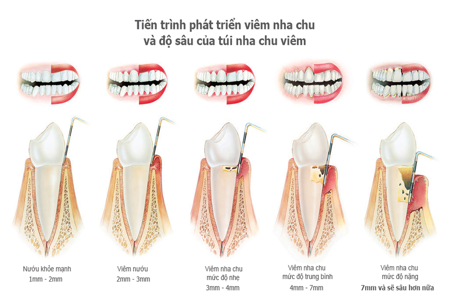 tiến trình phát triển viêm nha chu răng