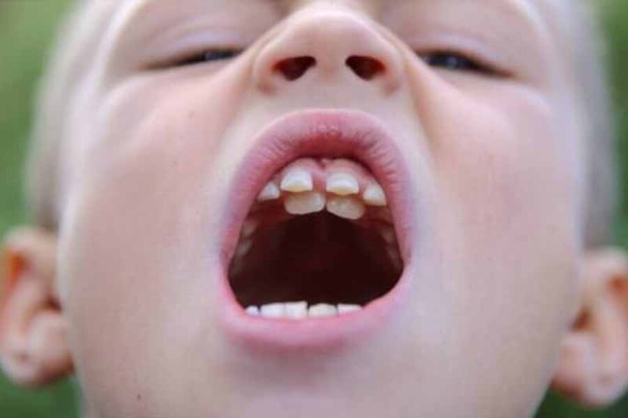 viêm nha chu ở trẻ em ảnh hưởng đến quá trình mọc răng