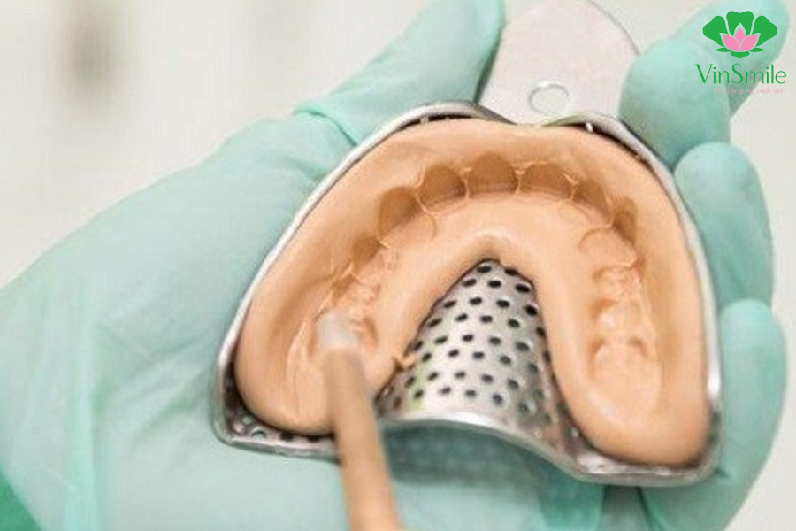 Niềng răng - Bác sĩ lấy dấu hàm để thực hiện việc thiết kế mắc cài