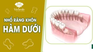 rang-khon-ham-duoi
