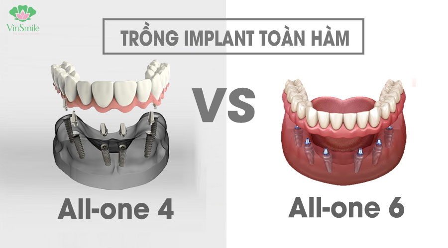 so-sanh-implant-toan-ham