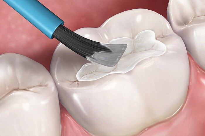 Trám răng giúp xử lý khuyết điểm răng khưa