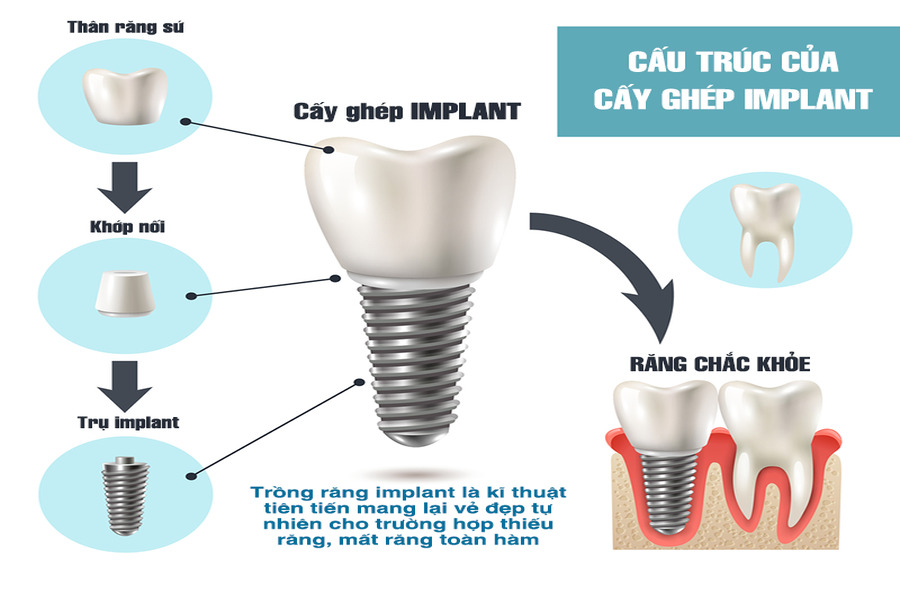 trụ implant trong cấu tạo răng implant