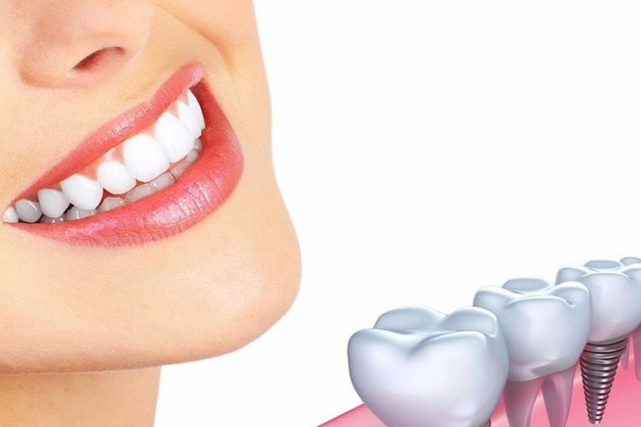 Chi phí trồng Implant răng cửa hiện nay là bao nhiêu?