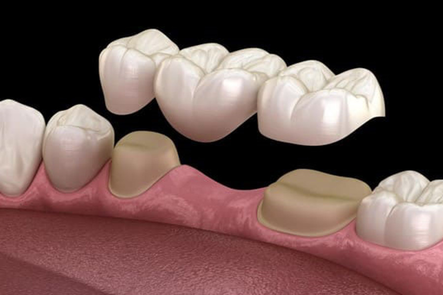 Cầu răng sứ thông thường