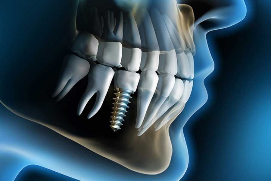 Chi phí trồng răng Implant một cái giá bao nhiêu?