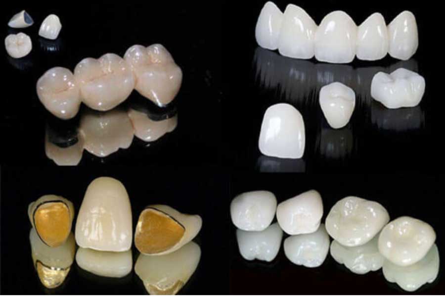 Răng sứ có tuổi thọ dài hay ngắn phụ thuộc vào loại sứ