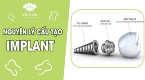 nguyen-ly-cau-tao-Implant