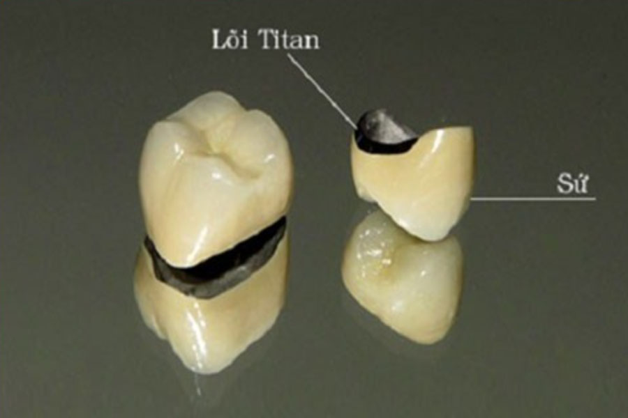 Cấu tạo cầu răng sứ titan