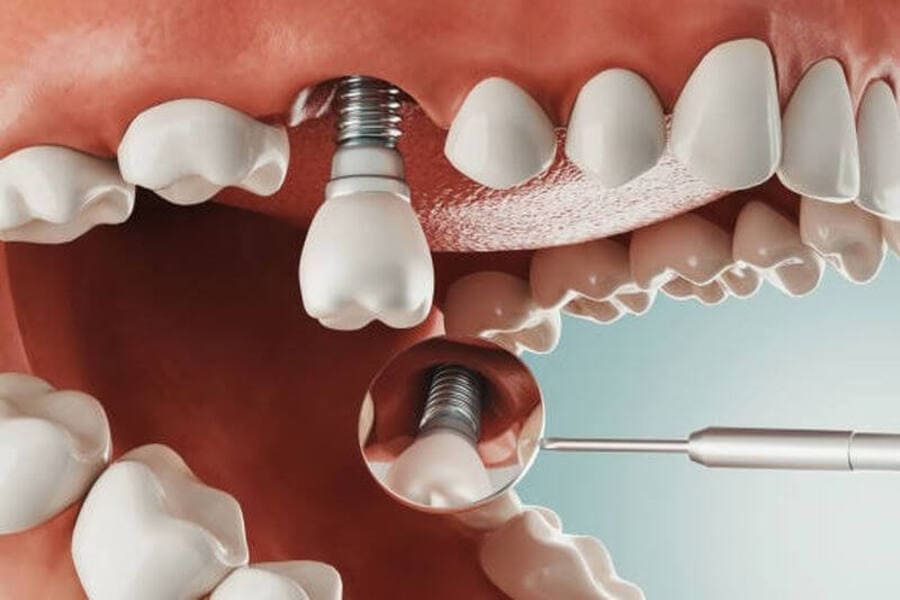 Trồng răng Implant giá rẻ