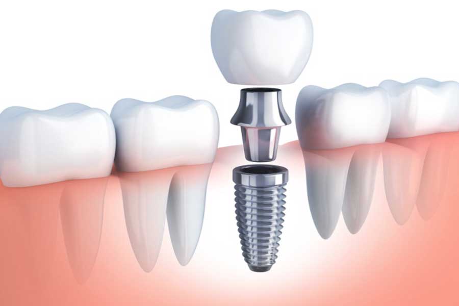 Cắm trụ implant được coi là biện pháp hiệu quả trong ngành phục hồi răng.