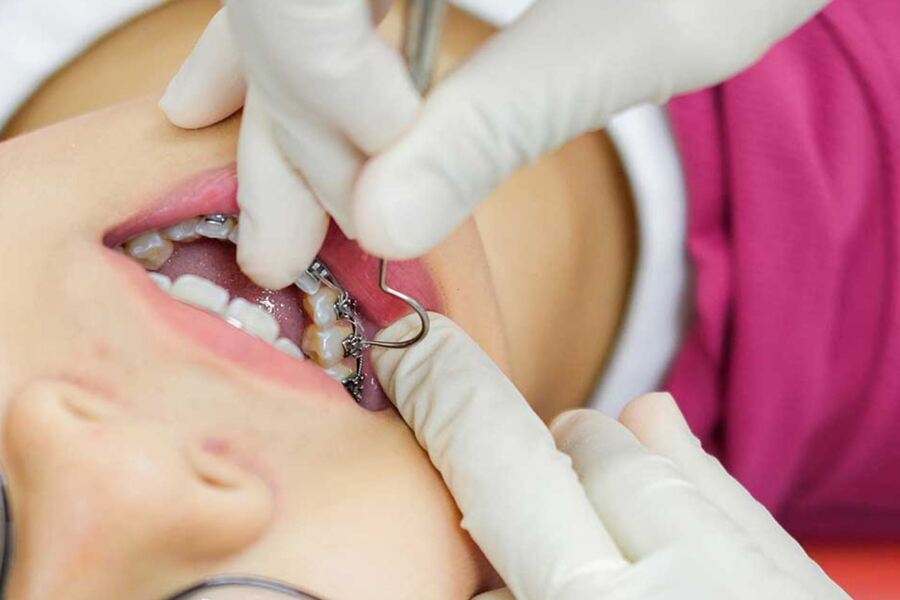Thăm khám bác sĩ theo định kỳ là cách tốt nhất giúp niềng răng không bị tụt lợi