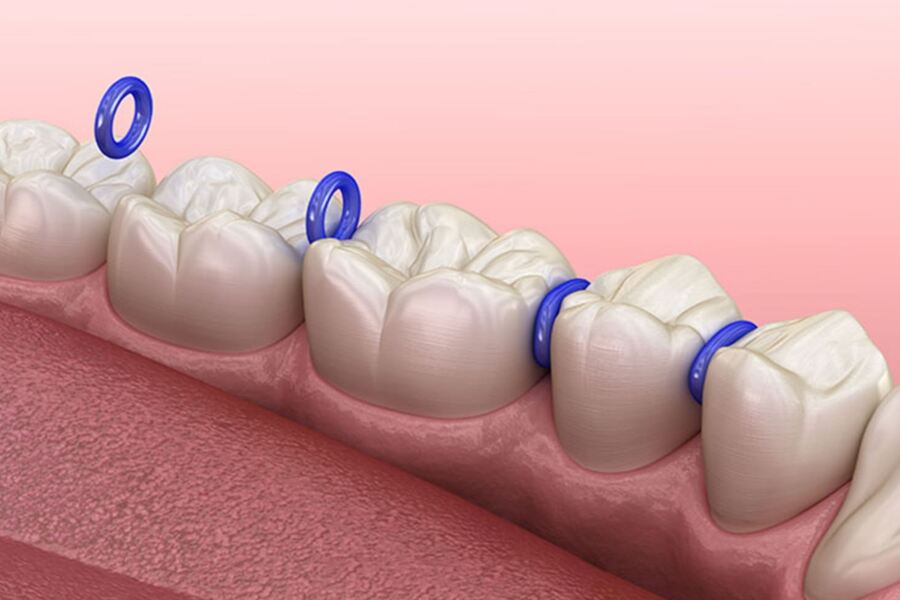 Siết mắc cài và dây cung để tạo lực kéo cho các răng dần dịch chuyển và thẳng hàng