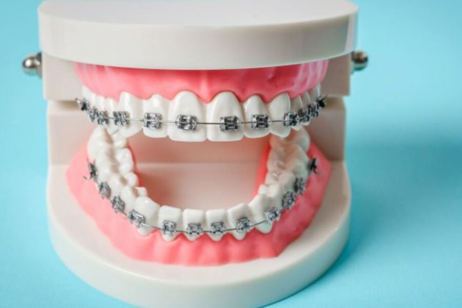 Niềng răng giai đoạn nào là xấu nhất?
