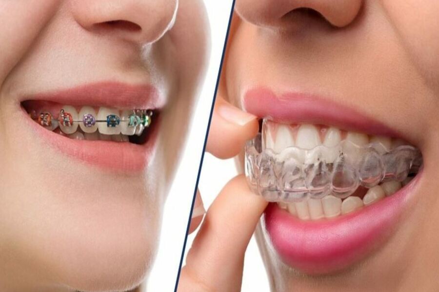 Phương pháp niềng răng mắc cài và niềng răng trong suốt
