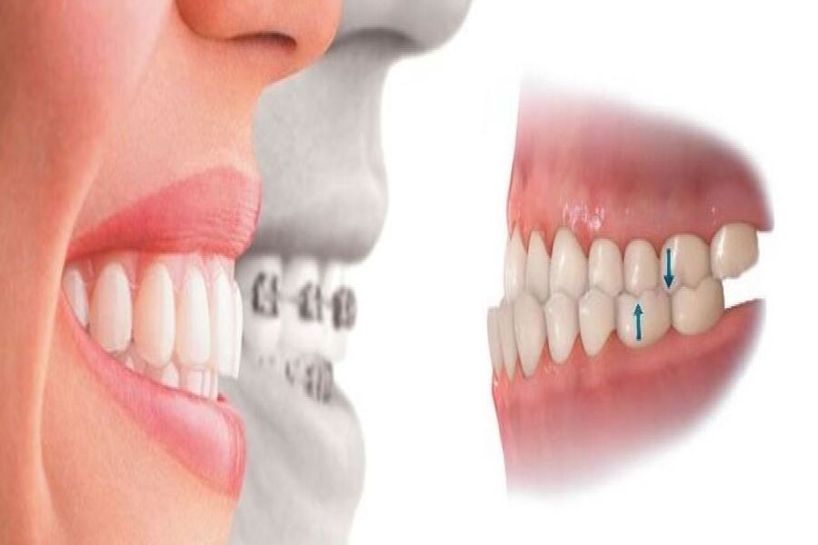Niềng răng có đau không còn phụ thuộc vào nhiều yếu tố