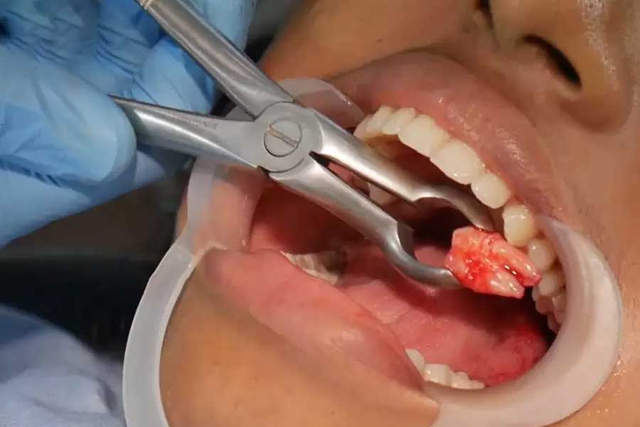 Niềng răng có phải nhổ răng không?
